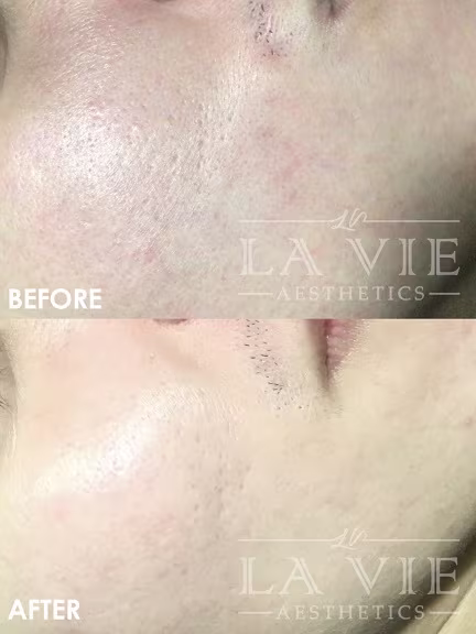 MRF (RF Microneedling) Promotion